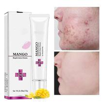 Kits de tratamentos de acne tratamento anti-manchas de acne cicatriz creme de cravo encolher poros clareamento