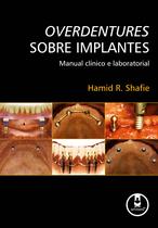 Livro - Overdentures Sobre Implantes