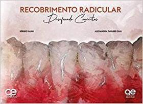 Livro -Recobrimento Radicular - Desafiando Conceitos - Kahn - Quintessence