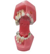 Macro arcada 5 anos nova edição com grade palatina fixa Macro arcada 5 anos nova edição com grade palatina fixa