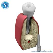 Macro Implante Parafusado