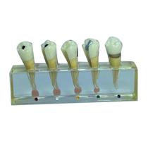 Macro Modelo Anatômico Odontológico Endodontia 4 Elementos Macro Modelo Anatômico Odontológico Endodontia 4 Elementos