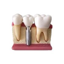 Macro Modelo contendo Ponte Fixa com 3 Elementos e 1 Macro Implante com Núcleo