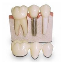 Macro Modelo contendo Ponte Fixa com 3 Elementos e Macro Implante