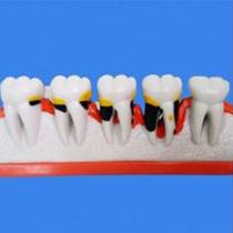 Macro Modelo Doença Periodontal com Furca e Bruxismo Sucesso