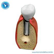 Macro Modelo Implante Cone Morse