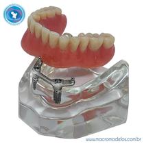 Macro Modelo Mandíbula Overdenture Acrílica com 2 Barra Bola e Prótese Inferior
