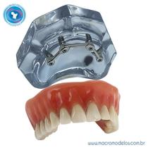 Macro Modelo Overdenture em Acrílico com 4 implantes Barra Clip