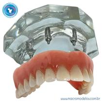 Macro Modelo Overdenture em Acrílico com 4 implantes Oring + Prótese Superior