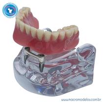 Macro Modelo Overdenture Mandíbula Acrílica Barra Clip + Prótese