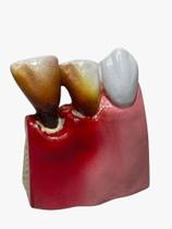 Macro modelo periodontal 3 dentes