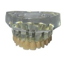 Macro Modelo Protocolo Superior c/ 08 Implantes Sem Gengiva