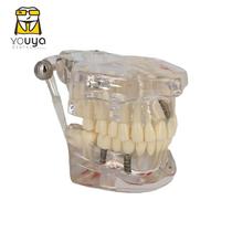 Manequim Modelo Dentário Ortodontia Dente Implante