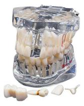 Manequim Odontológico Demonstrativo Canal Implantes Próteses