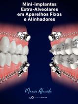 Mini-Implantes Extra-Alveolares Em Aparelhos Fixos E Alinhadores - Dental Press