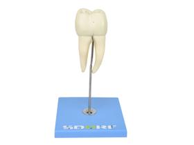 Modelo anatômico de dente molar inferior c/ raiz dupla em 3 partes c/ cárie,8x tamanho real sd5059e