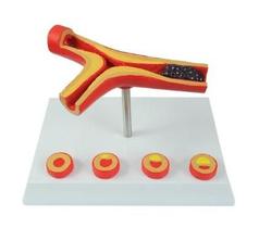 Modelo Anatômico de Oclusão Vascular