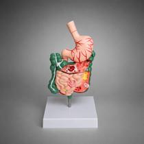 Modelo Anatômico do Sistema Digestivo com Patologias, com estômago seccionável Modelo Anatômico do Sistema Digestivo com Patologias, com estômago seccionável