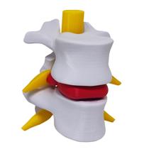 Modelo Anatômico Hérnia Disco Lombar Coluna Vertebral Ortopedia 3D Modelo Anatômico Hérnia Disco Lombar Coluna Vertebral Ortopedia 3D
