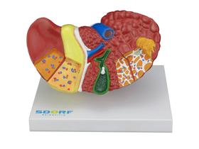 Modelo anatômico patológico do fígado e vesícula biliar sd5206