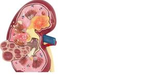 Modelo Anatômico Rim Com Patologia Pedra Rins Urológico