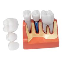 Modelo De Coroa Dentária Para Análise De Implante Removível