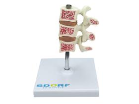 Modelo de Osteoporose - SDORF