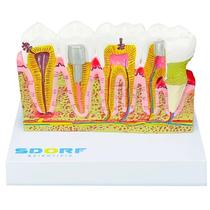 Modelo de patologias dentárias - sd5202 Modelo de patologias dentárias - sd5202