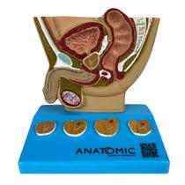 Modelo de Próstata, com Patologias Modelo de Próstata, com Patologias