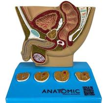 Modelo De Próstata, Com Patologias Modelo De Próstata, Com Patologias