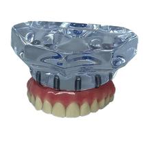 Modelo Superior Protocolo em Acrílico Maxila com 6 implantes
