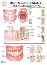Pôster Educativo dos Dentes Cárie Dentária e Doença Periodontal