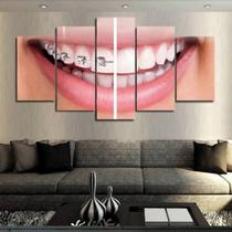 Quadro Decorativo Dentista Aparelho 63X130Mt Com 5 Peças