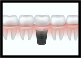Quadro Decorativo Dentista Consultórios Odontológicos Dentes Implantes Com Moldura RC022