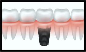 Quadro Decorativo Dentista Implantes Dentes Odontologia Consultórios Salas Com Moldura RC005 Quadro Decorativo Dentista Implantes Dentes Odontologia Consultórios Salas Com Moldura RC005
