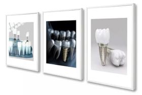 Quadro decorativo Odontologia Implante Dentista"