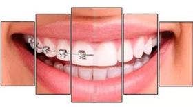 Quadro Decorativo Painel Sorriso Aparelho Metade"