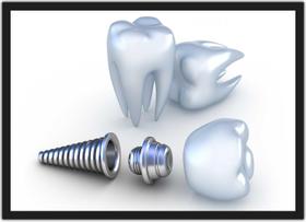 Quadro Decorativo Profissão Dentista Odontologia Implante Dentes Consultórios Com Moldura G04