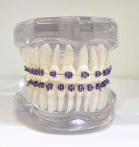 Ro-046 a classe i c/ braquete metálico (téc. edgewise) tubo colagem - transparente Ro-046 a classe i c/ braquete metálico (téc. edgewise) tubo colagem - transparente