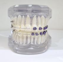 Ro-047 a classe i c/ braquete estético/ metalico (téc. roth) tubo e banda e 1 mi - transparente Ro-047 a classe i c/ braquete estético/ metalico (téc. roth) tubo e banda e 1 mi - transparente