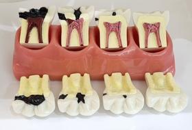 Rv-003 macro evolução da cárie rosa ou transp