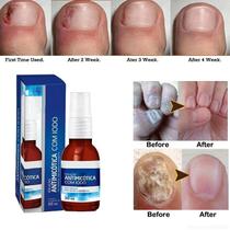 Spray De Iodo Para Feridas De Micose No Pé - Solução Antifúngica E Cicatrizante Para Frieira