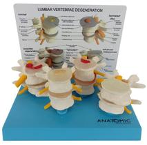 Vértebras Demonstração de Degeneração em 4 Fases Anatomia