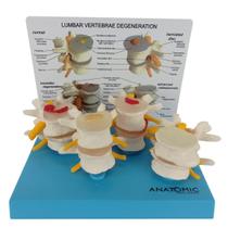 Vértebras Demonstração de Degeneração em 4 Fases Anatomia - ANATOMIC