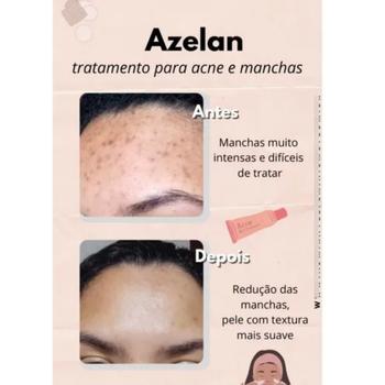 Imagem de Azelan Ácido Azelaico Creme Tratamento Espinha Acne 30g