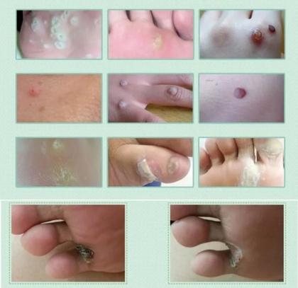 Imagem de 12 Adesivos Calos e Verrugas