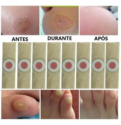 Imagem de 12 Adesivos Calos e Verrugas