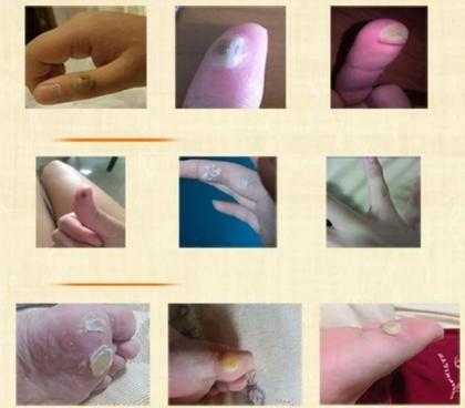 Imagem de 12 Adesivos Calos e Verrugas