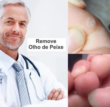 Imagem de 24 Adesivos Calos e Verrugas