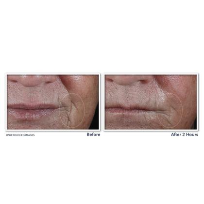 Imagem de Adesivos Anti-rugas RoC Retinol Correxion Deep Wrinkle (6 Unidades)